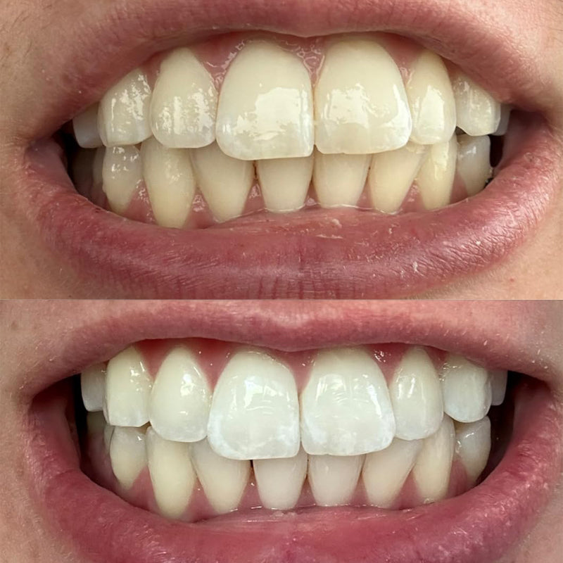 đ§Smileasego⢠Whitening Remineralizing Tooth Powder, Fluoridfrei, Zahnpolitur & Fleckenentferner