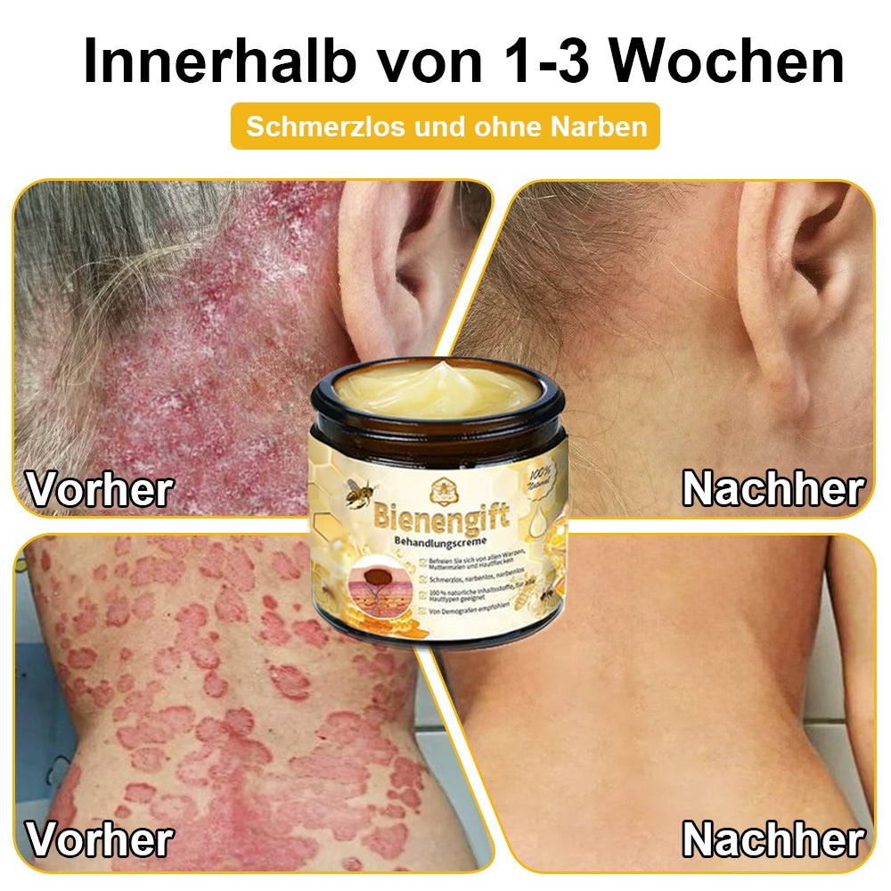 [Zusätzliche 30 % Rabatt] TLOPA® Fortgeschrittene Bienengift Behandlungscreme (🔥Letzter Tag Aktion 80 % Rabatt) 