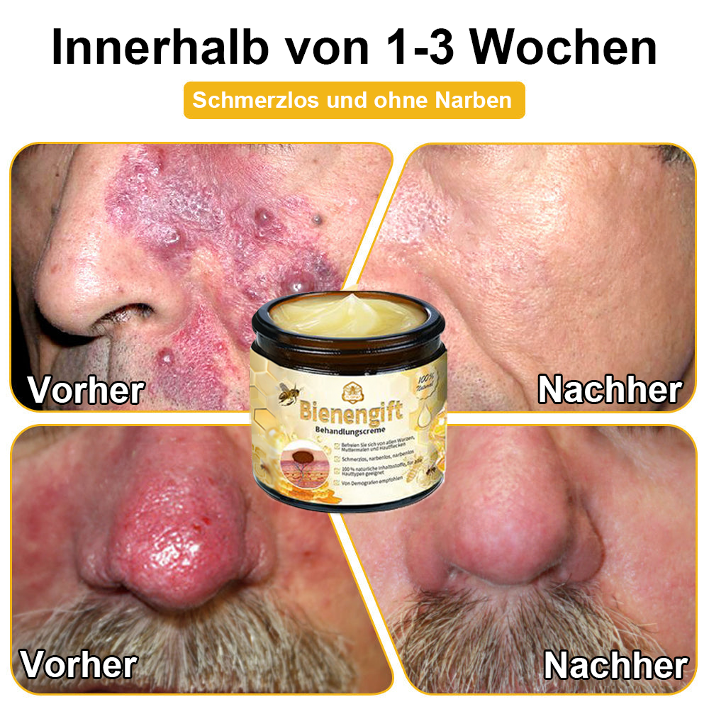 [Zusätzliche 30 % Rabatt] TLOPA® Fortgeschrittene Bienengift Behandlungscreme (🔥Letzter Tag Aktion 80 % Rabatt) 