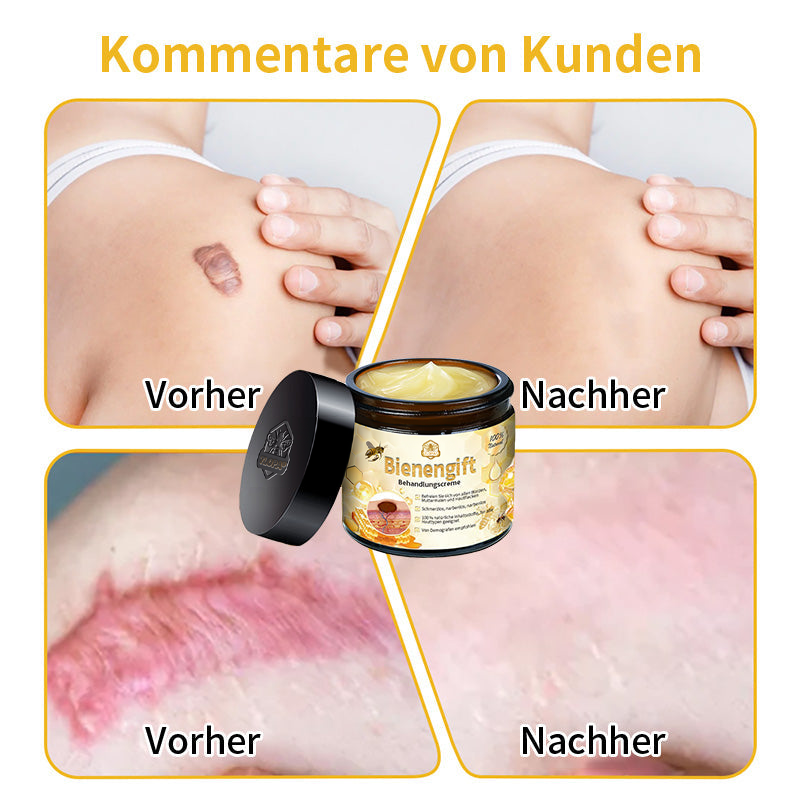 [Zusätzliche 30 % Rabatt] TLOPA® Fortgeschrittene Bienengift Behandlungscreme (🔥Letzter Tag Aktion 80 % Rabatt) 